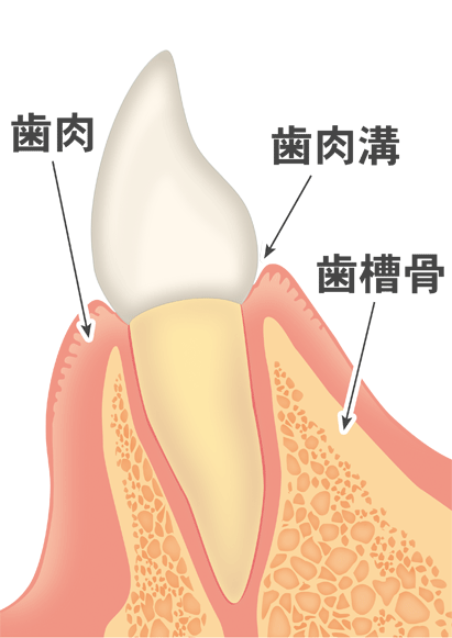 歯肉炎