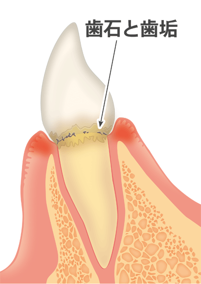 軽度歯周炎