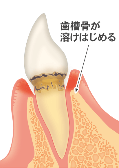 中等度歯周炎