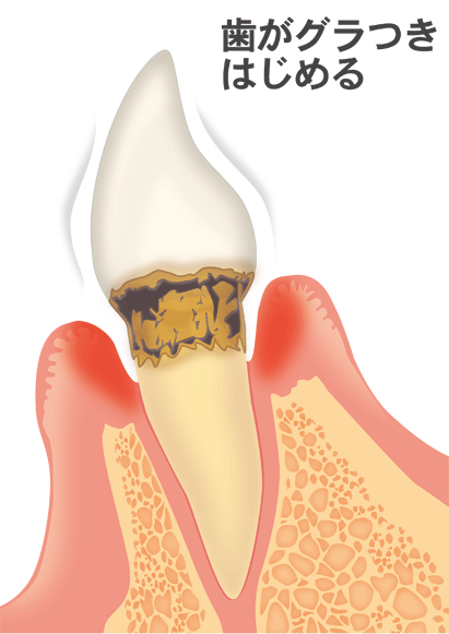 歯周病後期（重度歯周炎）