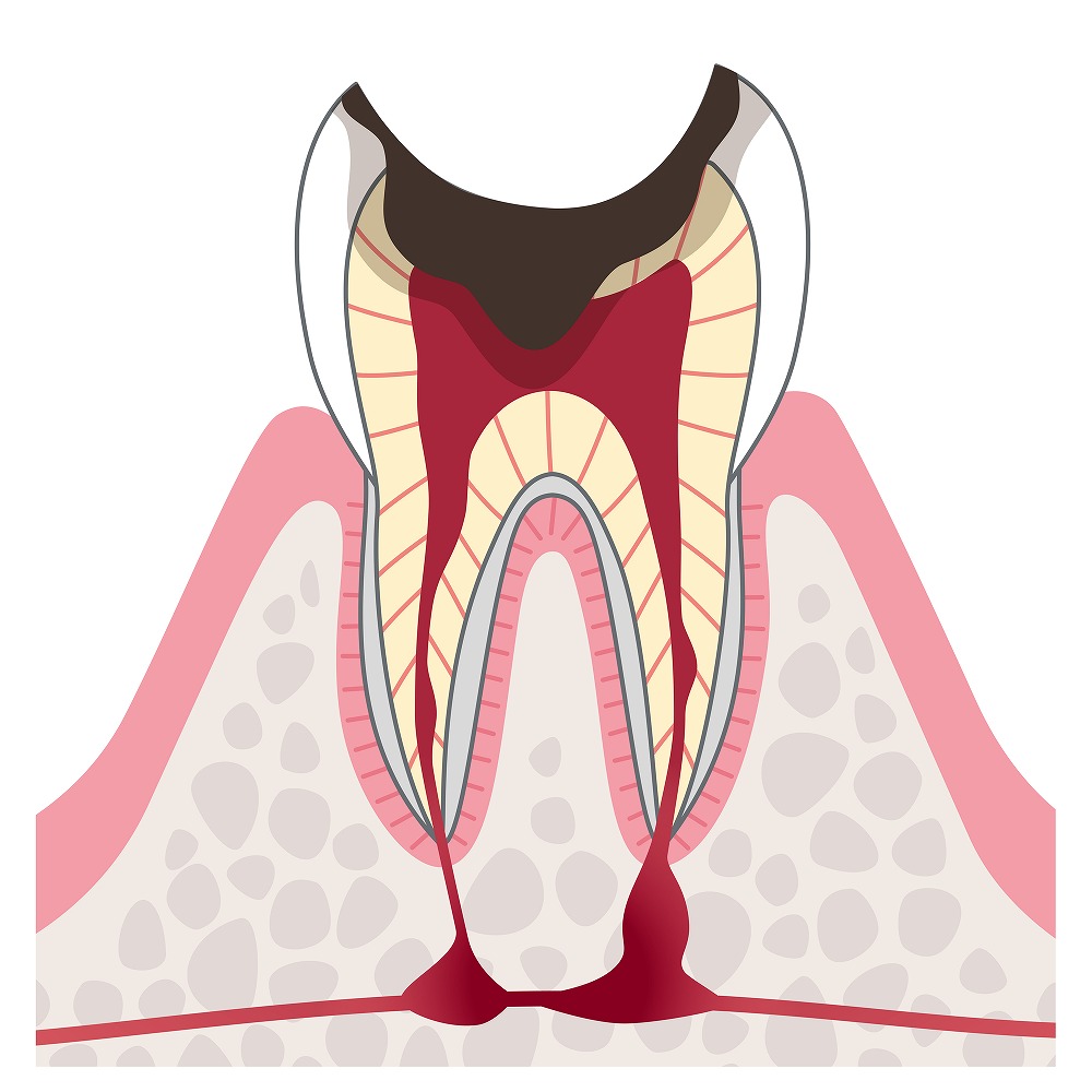 C4歯根だけが残ったむし歯