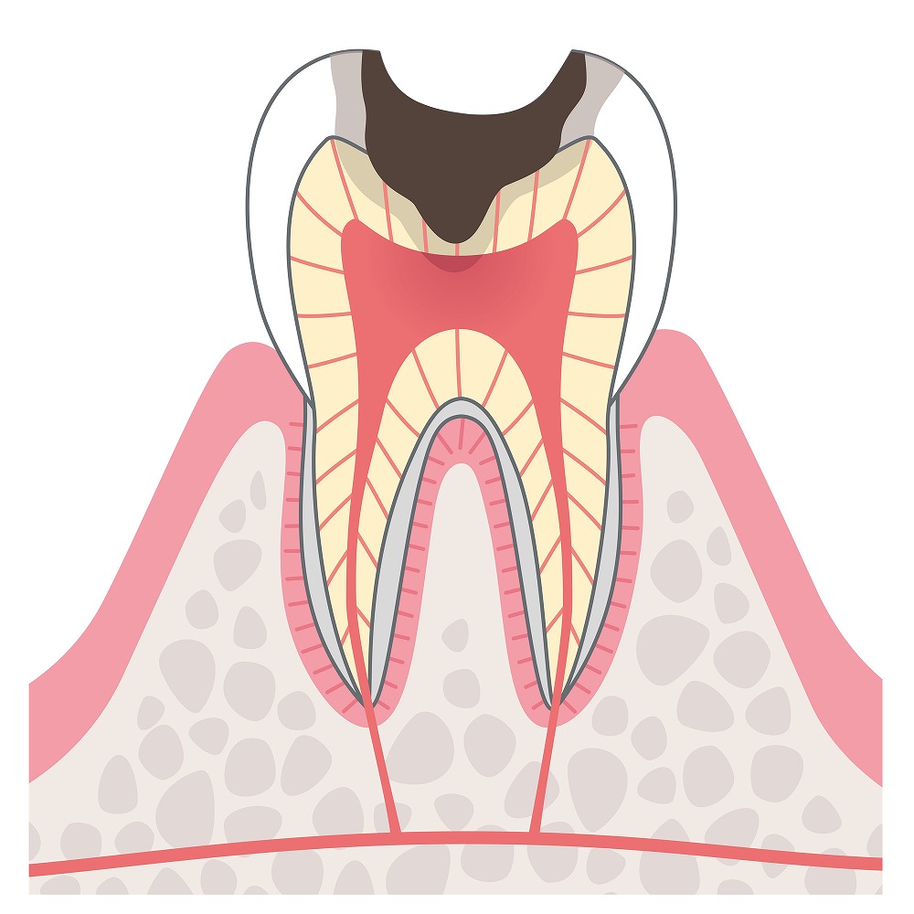 C3歯の神経（歯髄）まで進行したむし歯