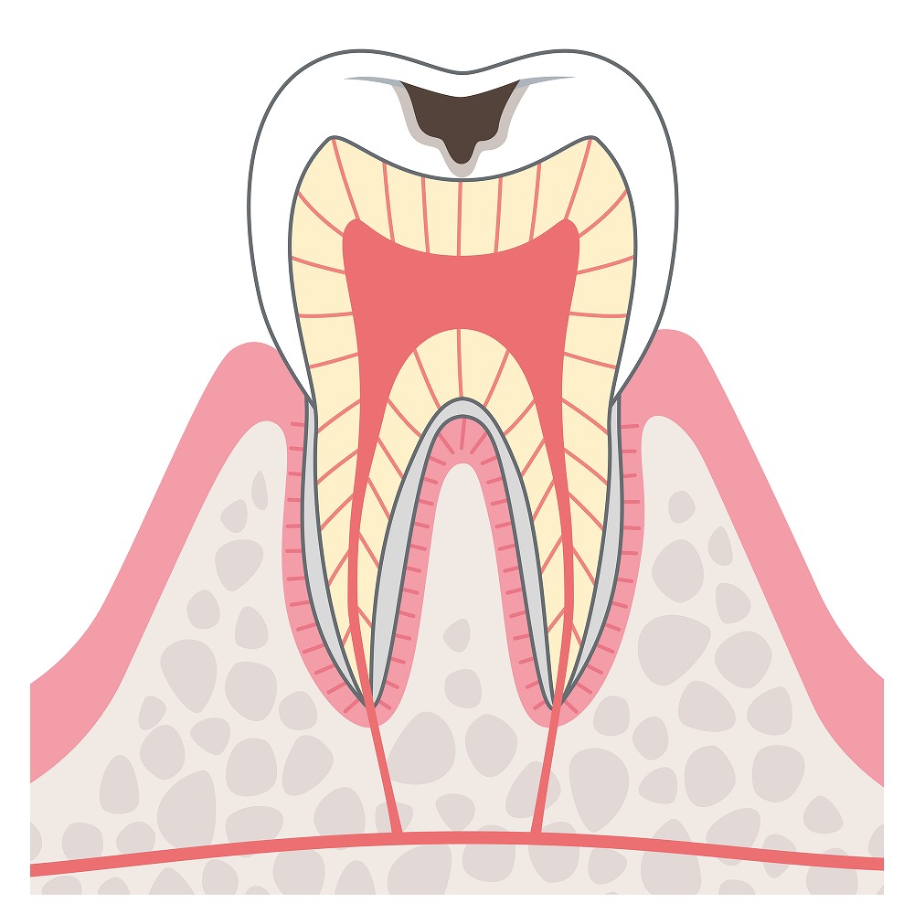 C2象牙質まで進行したむし歯