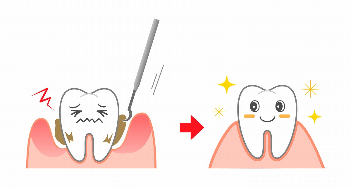 歯垢・歯石除去