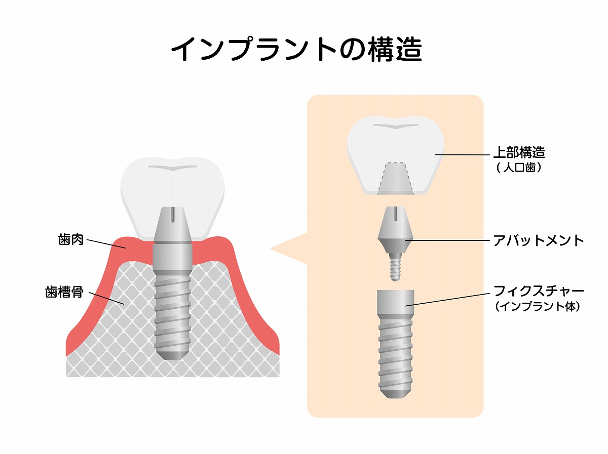 インプラント治療とは？