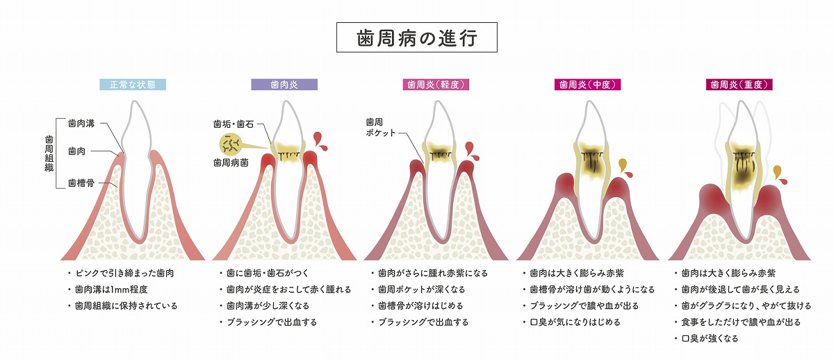 歯周病治療とは？